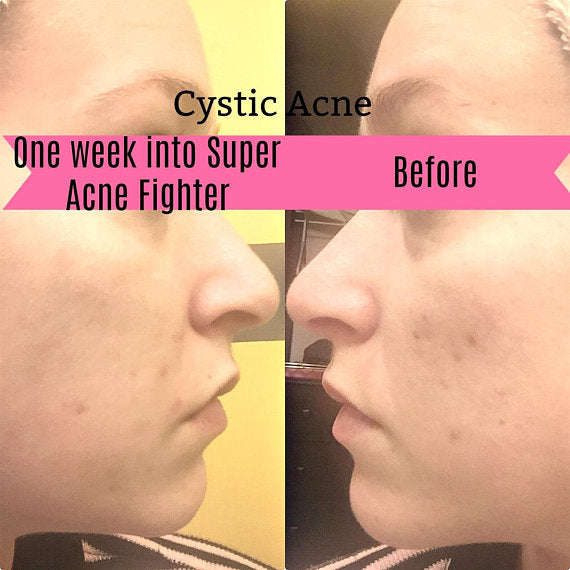 Super Acne Fighter / Organic Acne Treatment / Acne Skincare Butter Me Up Organics 
