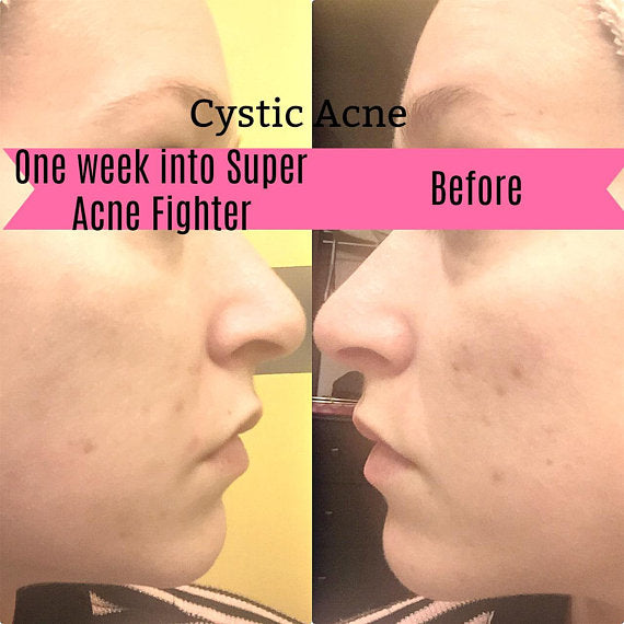 Super Acne Fighter / Organic Acne Treatment / Acne Skincare Butter Me Up Organics
